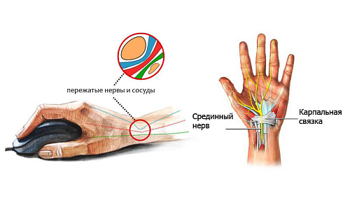Туннельный синдром запястья фото